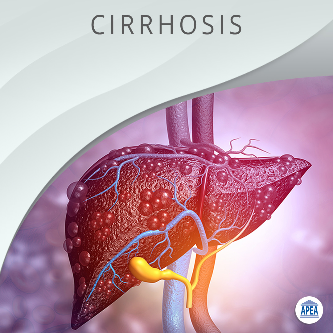 Managing the Patient with Cirrhosis